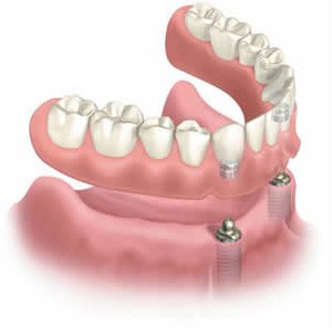 implant-supported-denture1.jpg