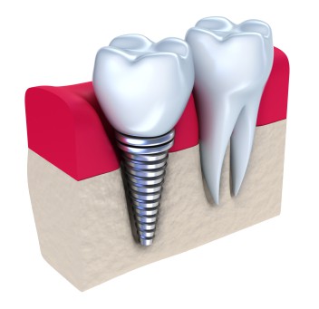 dental-implants-1.jpg